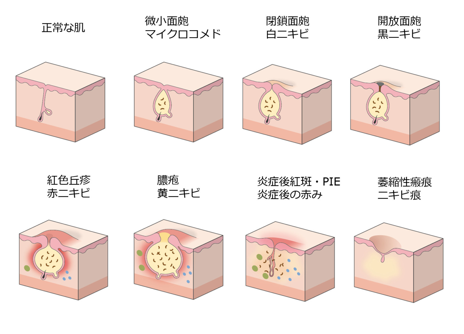 美容診療|症状から探す - ニキビ・ニキビ跡 - 奈良県香芝市の内科・呼吸器内科・美容皮膚科 | ノアクリニック | NOA CLINIC