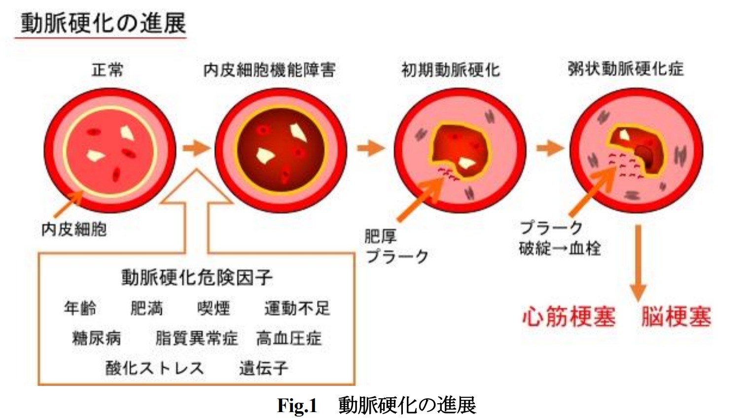 頸動脈エコー検査について①；動脈硬化を早期発見 - 奈良県香芝市の 